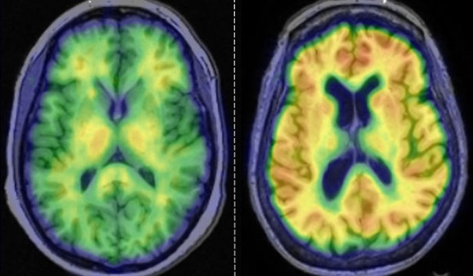 Two brain scans highlighting brain activity