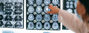 A physician pointing to medical scans of a brain
