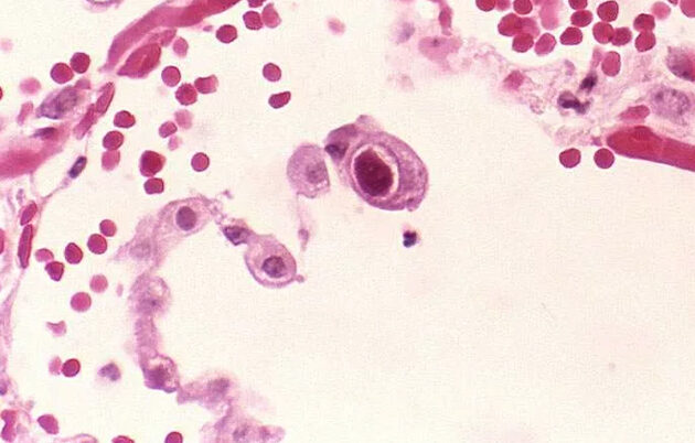 Cell under a microscope shows enlarged nuclei characteristic of cytomegalovirus