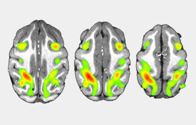 Three brain scans highlighting brain activity