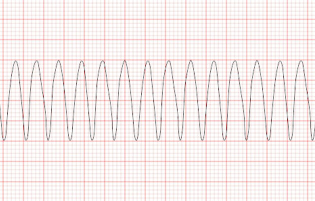 ventricular tachycardia ECG