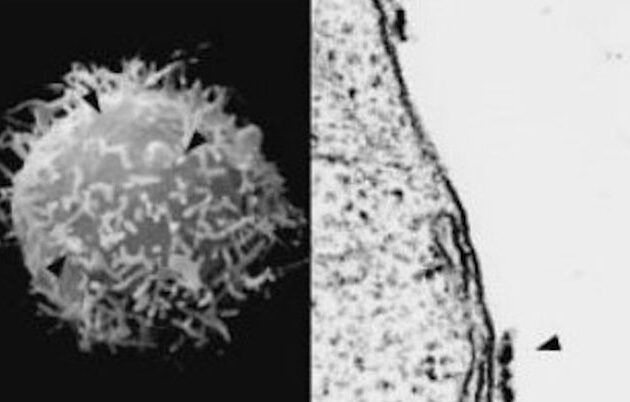 clinical trial targets recurrent BK infection in kidney transplant recipients