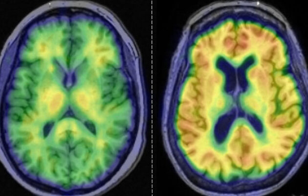 Amyloid PET scans
